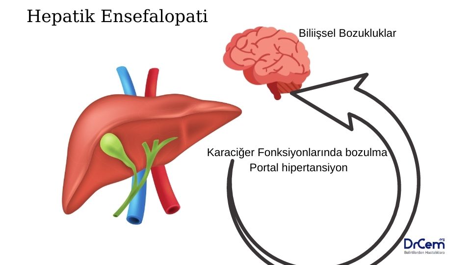 Hepatik ensefalopati görseli - DrCem hastalık rehberi